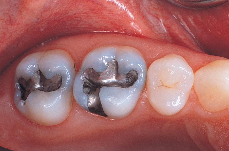 silver-fillings-before.jpg